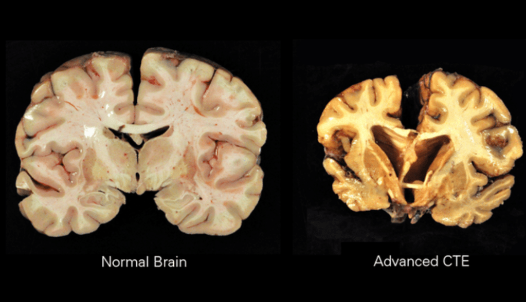 What is ‘CTE’ and do People Need to be Afraid? 